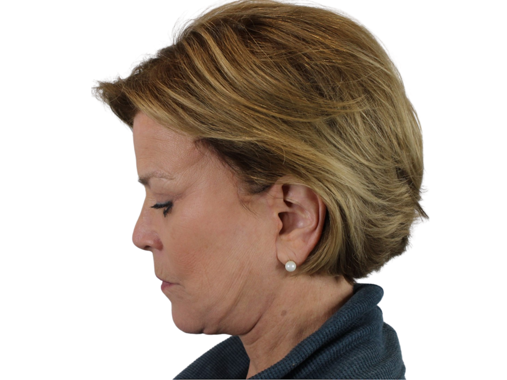 Deep Plane Facelift Before & After Gallery - Patient 118972199 - Image 14