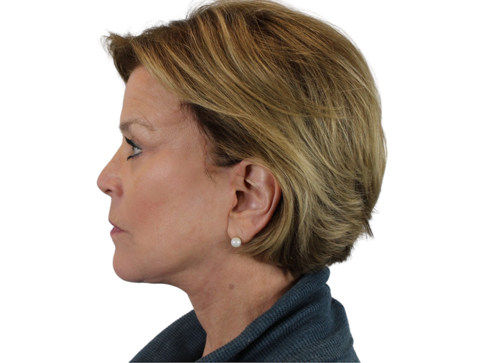 Deep Neck Lift Before & After Gallery - Patient 118972217 - Image 6