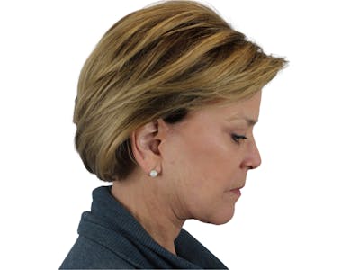 Deep Plane Facelift Before & After Gallery - Patient 118972199 - Image 12