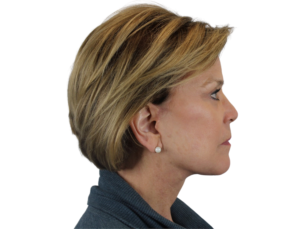 Deep Plane Facelift Before & After Gallery - Patient 118972199 - Image 10