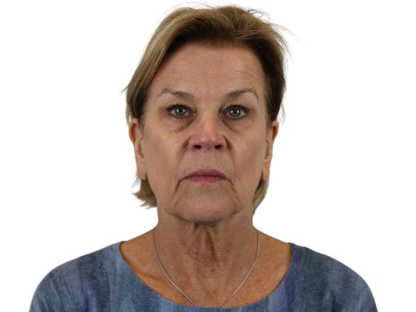 before and after neck lift in Phoenix