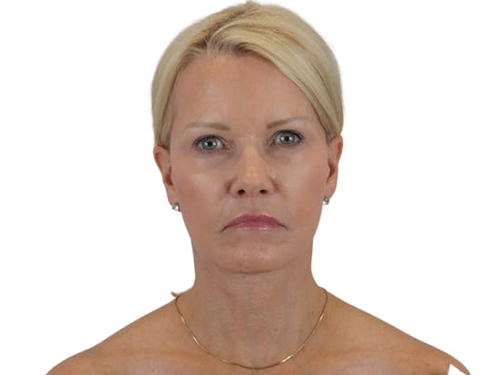before and after neck lift in Scottsdale