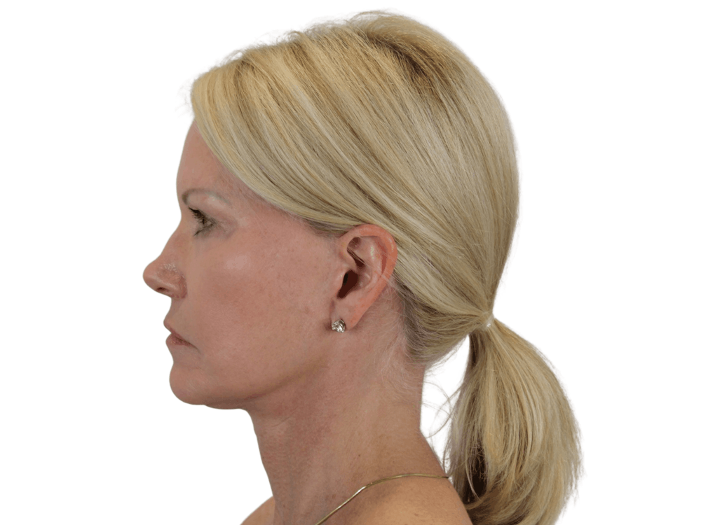 Deep Neck Lift Before & After Gallery - Patient 120947130 - Image 4