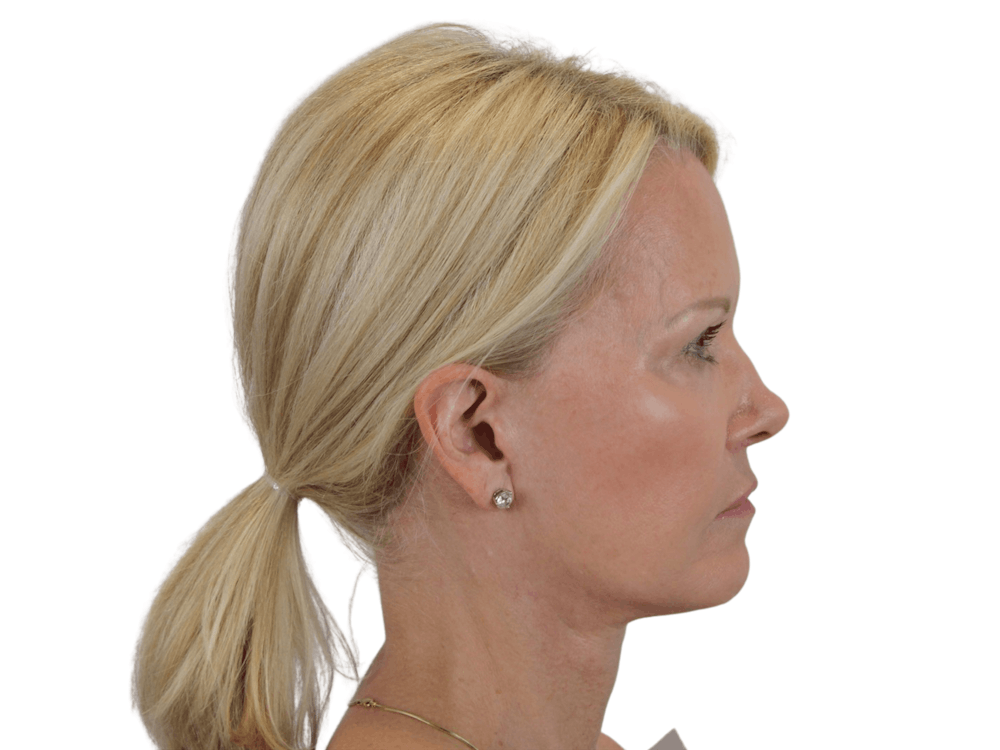 Deep Plane Facelift Before & After Gallery - Patient 120947126 - Image 6