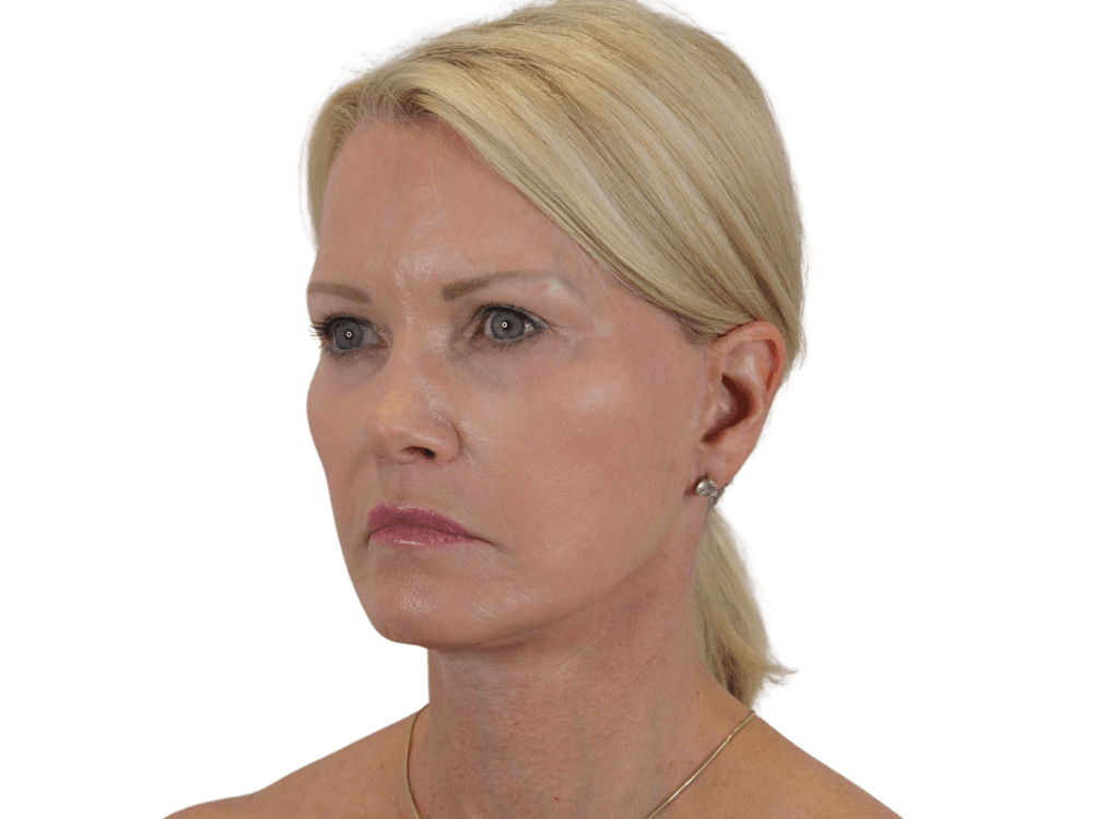 Deep Plane Facelift Before & After Gallery - Patient 120947126 - Image 8