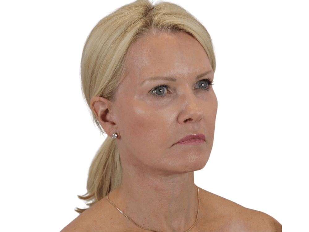 Deep Plane Facelift Before & After Gallery - Patient 120947126 - Image 10