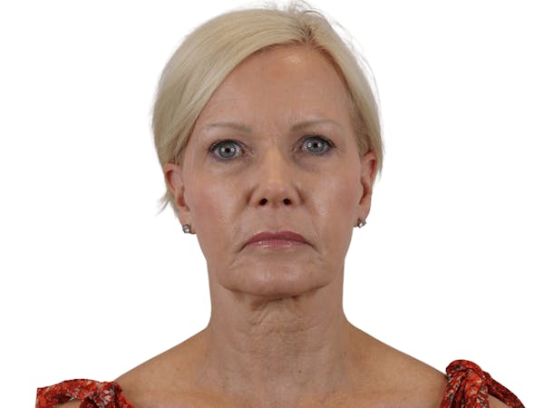 before and after neck lift in Scottsdale