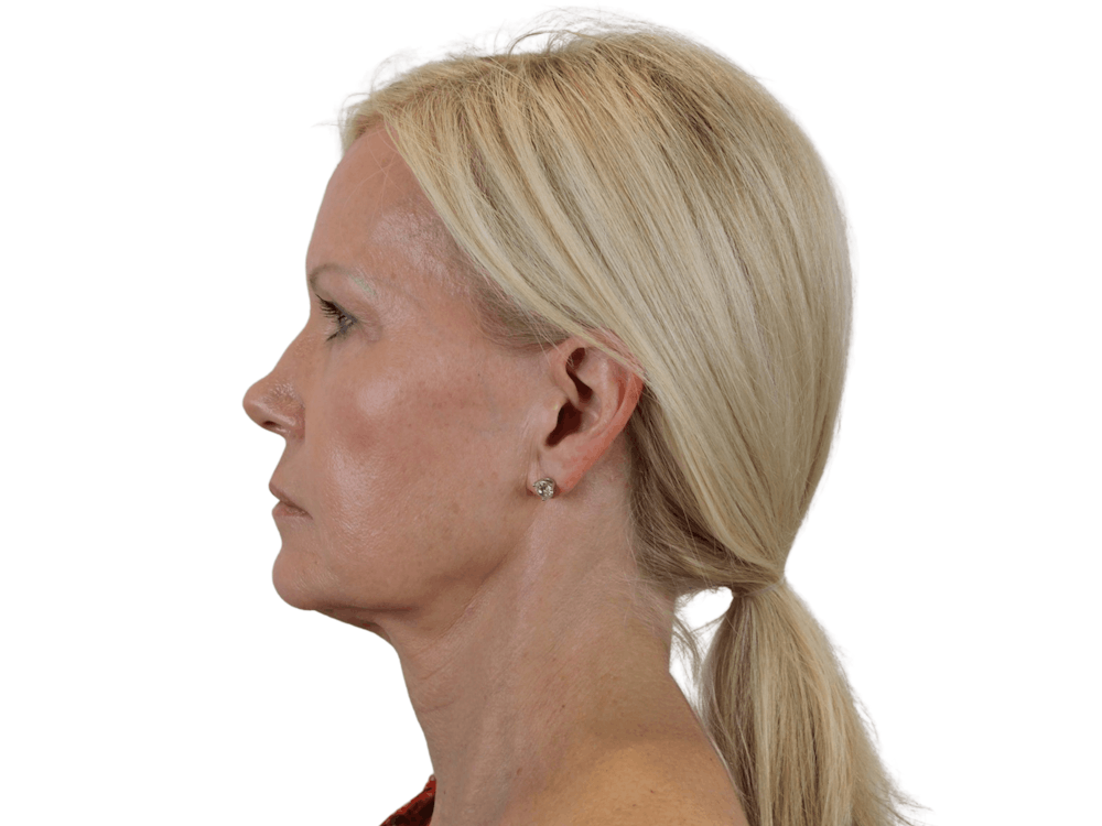 Deep Plane Facelift Before & After Gallery - Patient 120947126 - Image 3