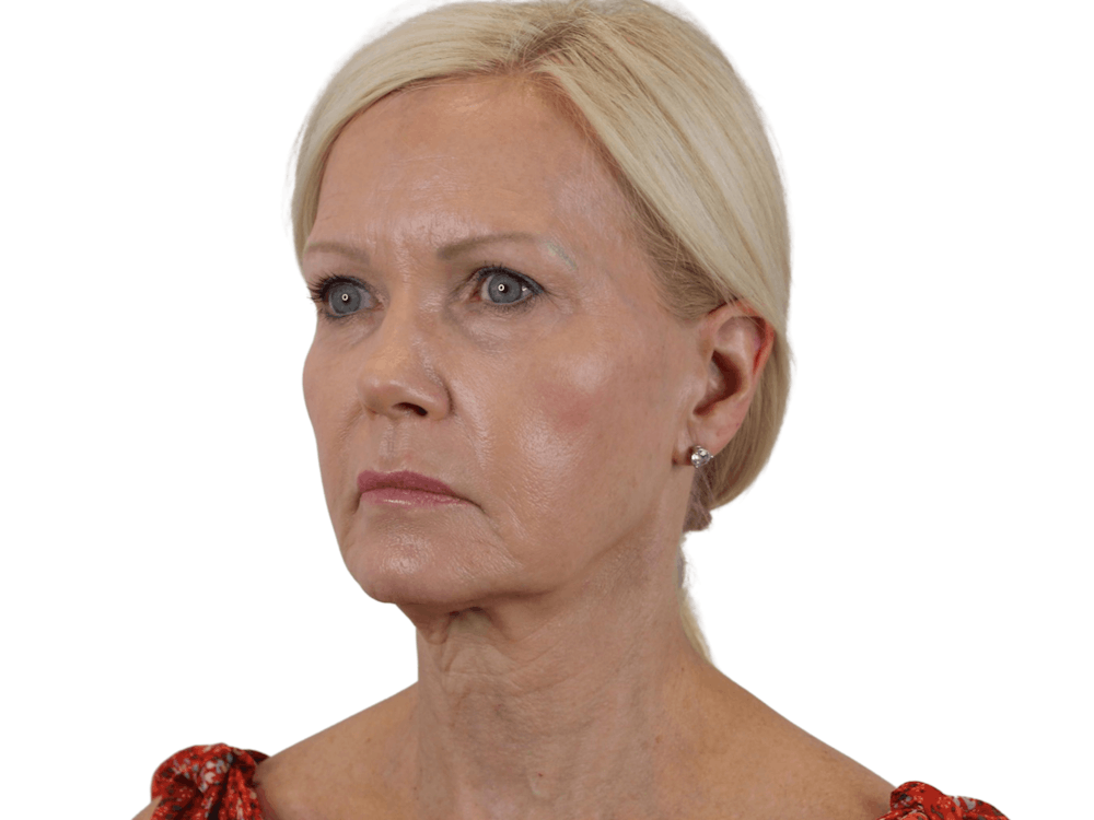 Deep Plane Facelift Before & After Gallery - Patient 120947126 - Image 7