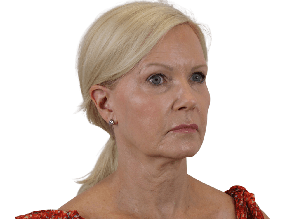 Deep Plane Facelift Before & After Gallery - Patient 120947126 - Image 9