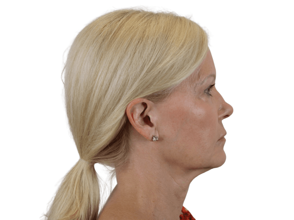 Deep Plane Facelift Before & After Gallery - Patient 120947126 - Image 5