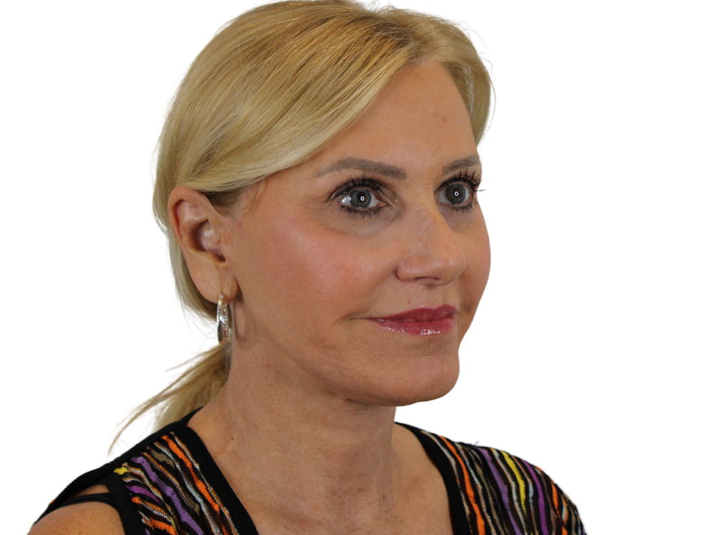 Deep Plane Facelift Before & After Gallery - Patient 121595721 - Image 4
