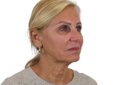 Neck Lift Before & After Gallery - Patient 121595731 - Image 1