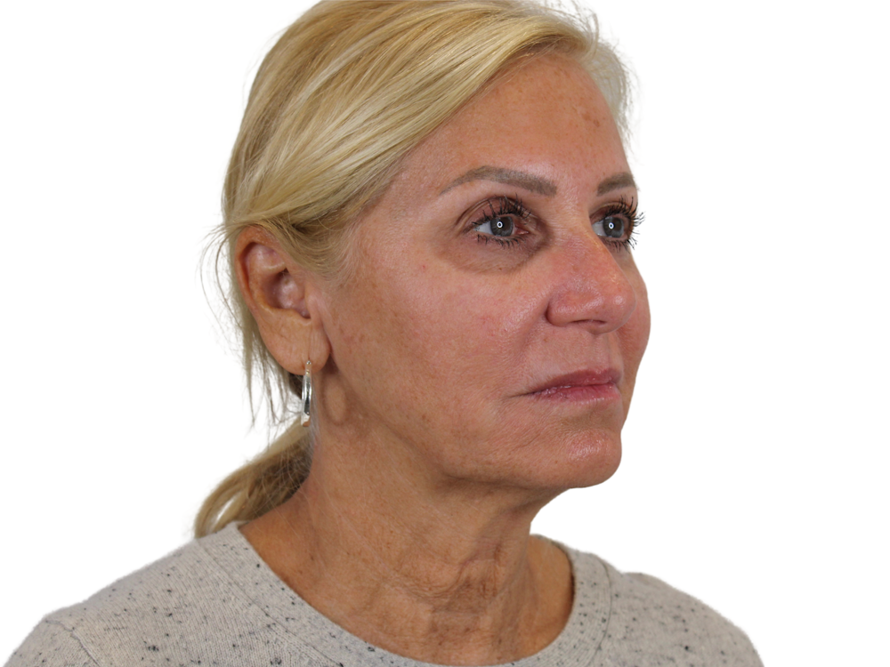 Deep Plane Facelift Before & After Gallery - Patient 121595721 - Image 3