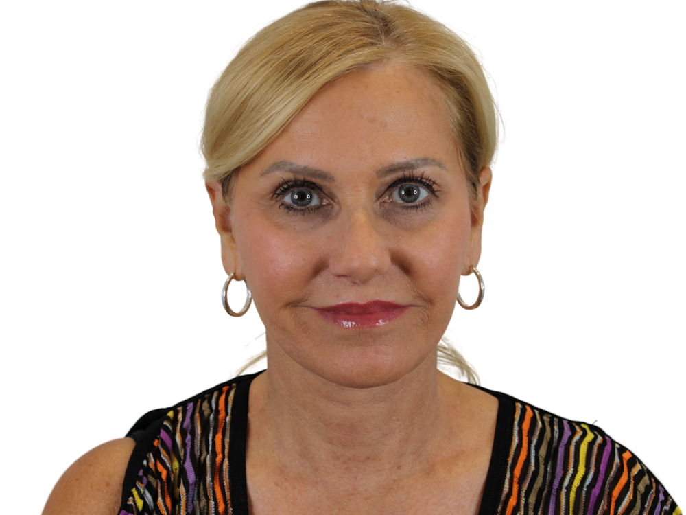 Deep Plane Facelift Before & After Gallery - Patient 121595721 - Image 2