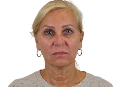 Deep Plane Facelift Before & After Gallery - Patient 121595721 - Image 1