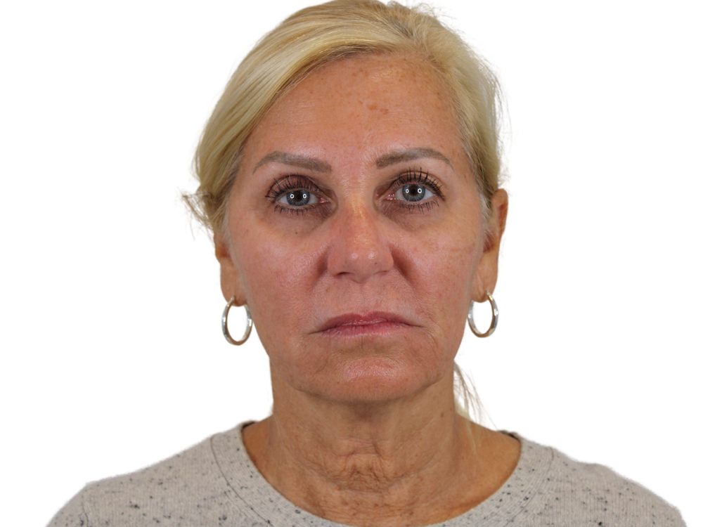 Deep Plane Facelift Before & After Gallery - Patient 121595721 - Image 1