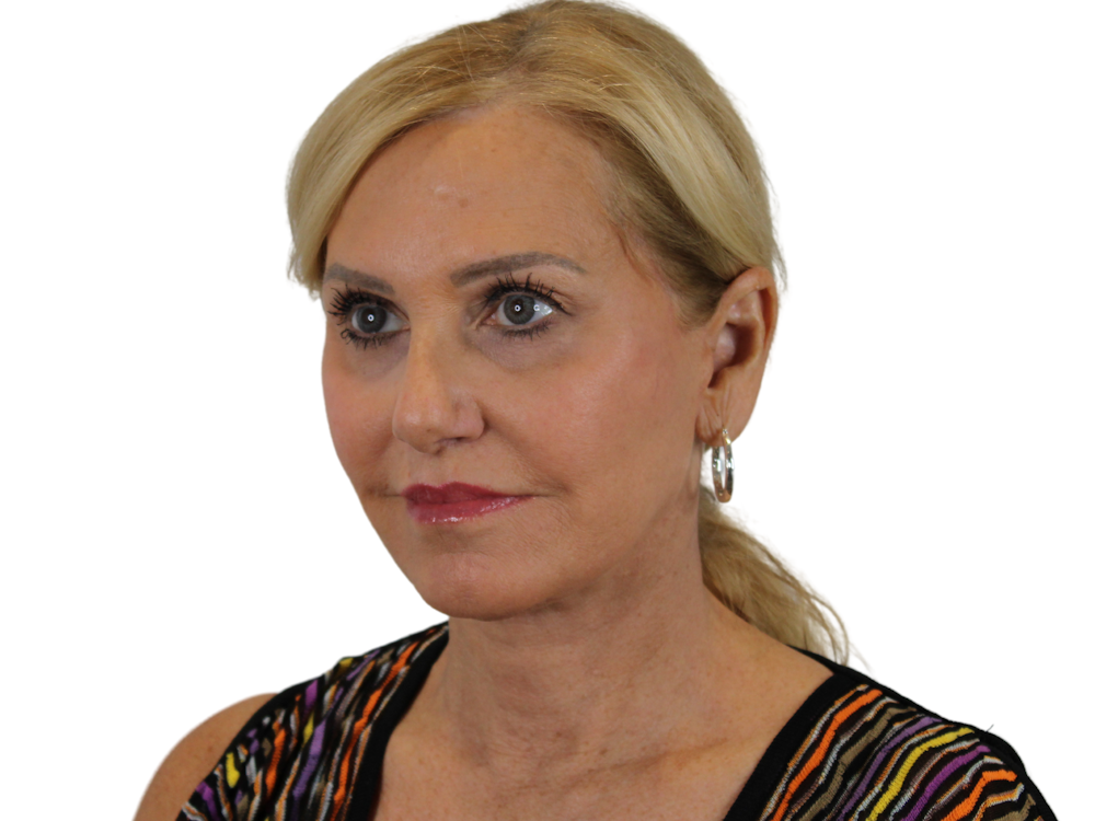 Deep Plane Facelift Before & After Gallery - Patient 121595721 - Image 6