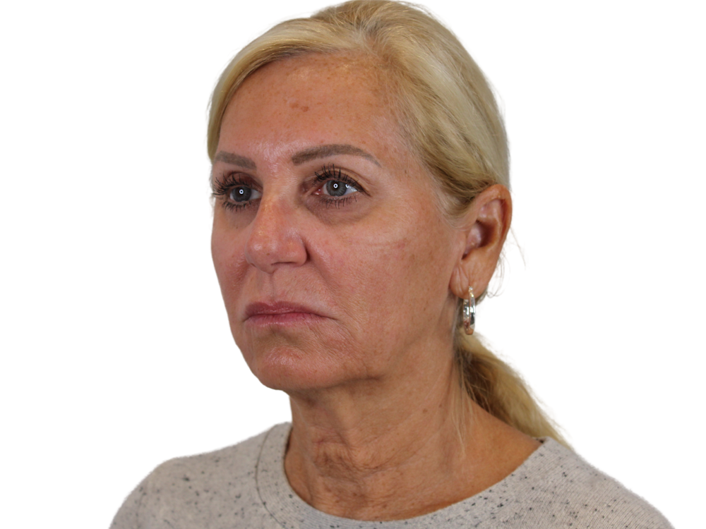 Deep Plane Facelift Before & After Gallery - Patient 121595721 - Image 5