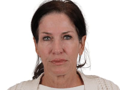 Facelift Before & After Gallery - Patient 121845160 - Image 1