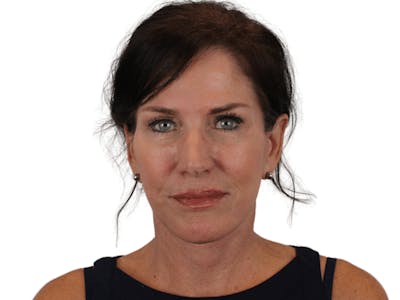 Facelift Before & After Gallery - Patient 121845160 - Image 2