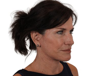 Facelift Before & After Gallery - Patient 121845160 - Image 4