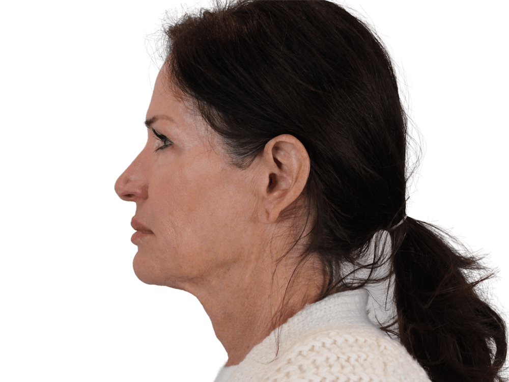 Neck Lift Before & After Gallery - Patient 121845161 - Image 7