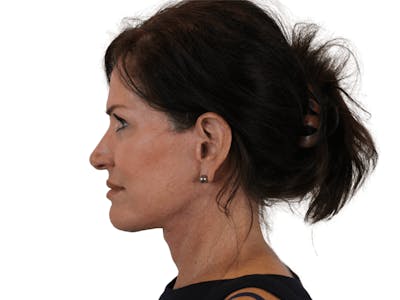 Facelift Before & After Gallery - Patient 121845160 - Image 8