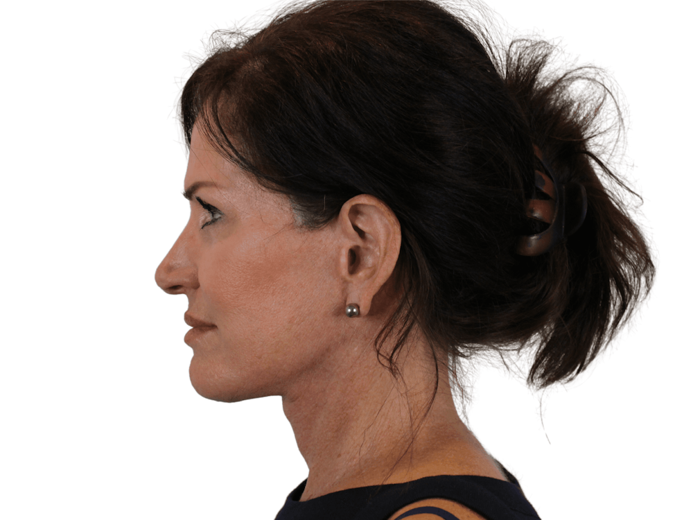 Deep Plane Facelift Before & After Gallery - Patient 121845160 - Image 8