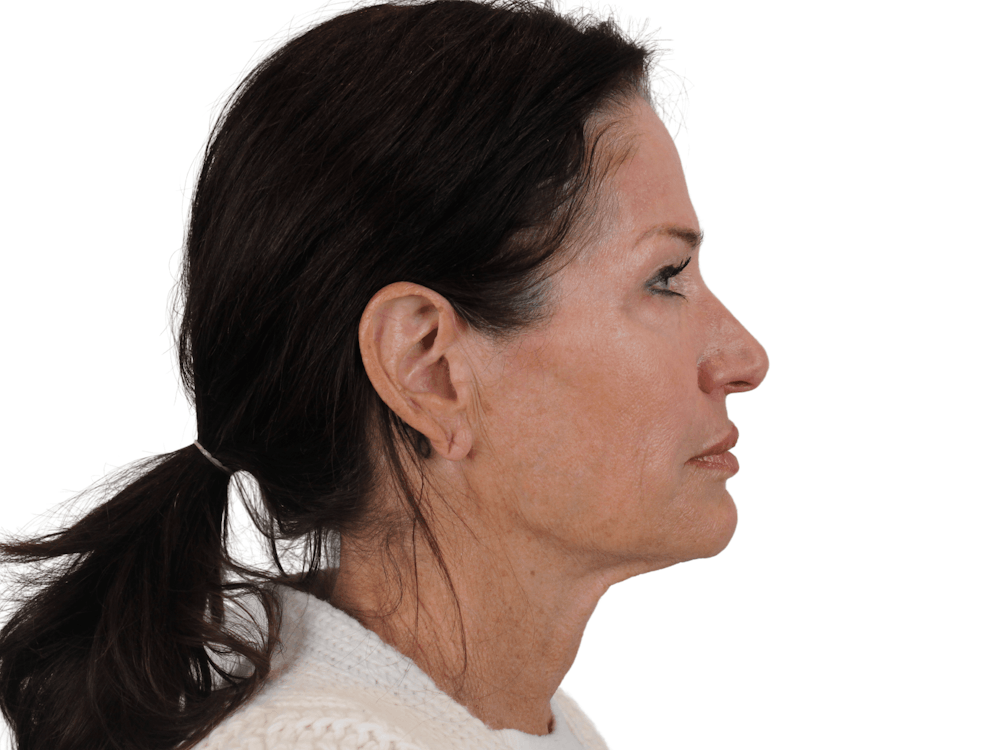 Facelift Before & After Gallery - Patient 121845160 - Image 9