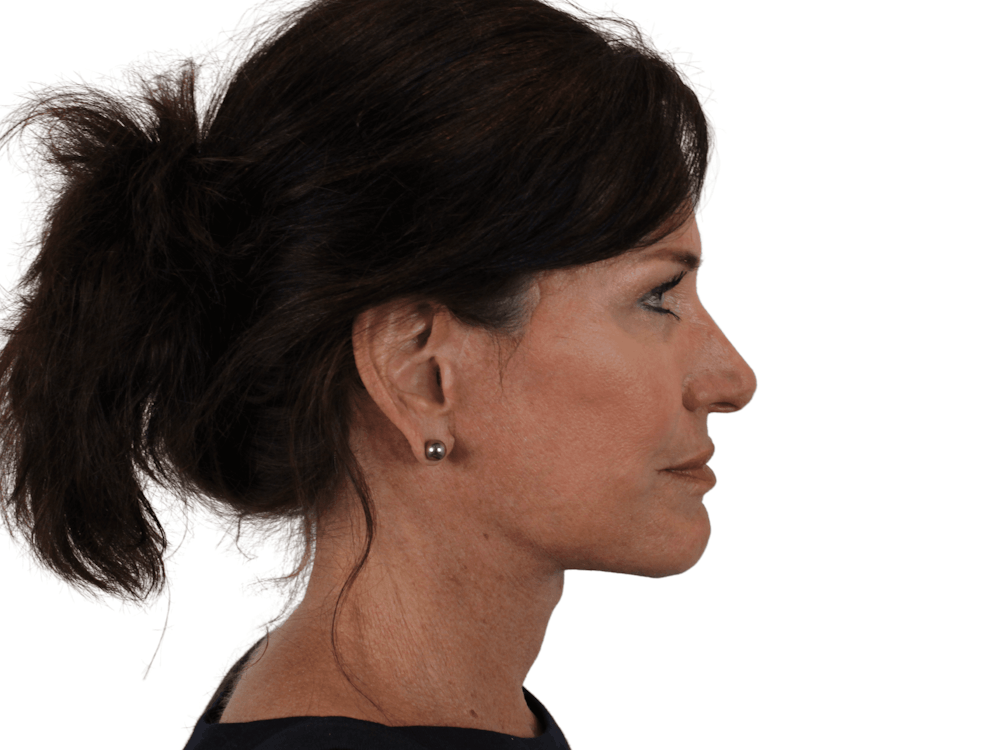 Facelift Before & After Gallery - Patient 121845160 - Image 10