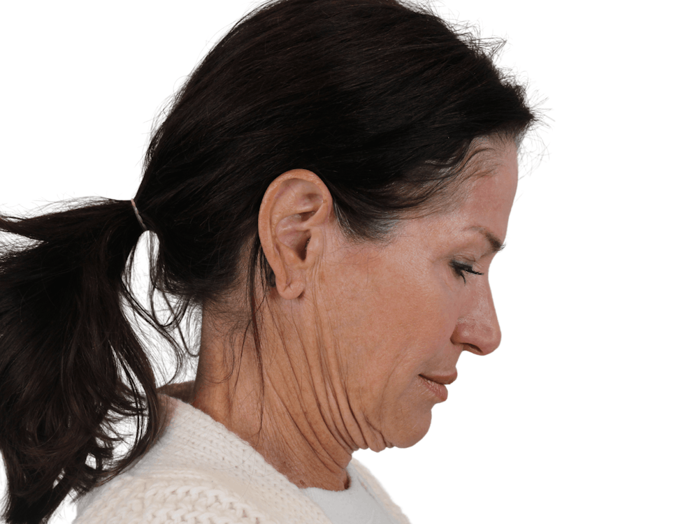 Deep Plane Facelift Before & After Gallery - Patient 121845160 - Image 11