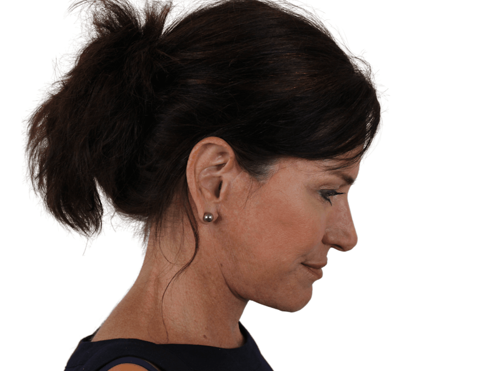 Neck Lift Before & After Gallery - Patient 121845161 - Image 12