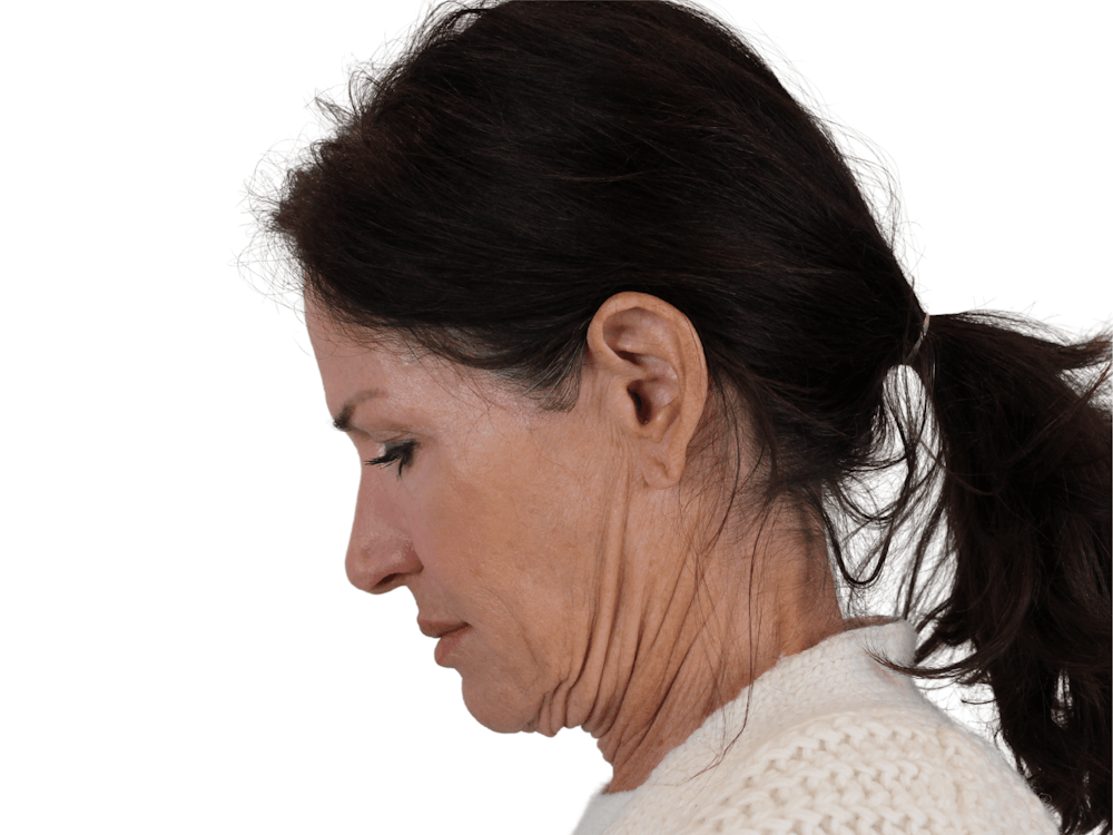 Deep Neck Lift Before & After Gallery - Patient 121845161 - Image 13