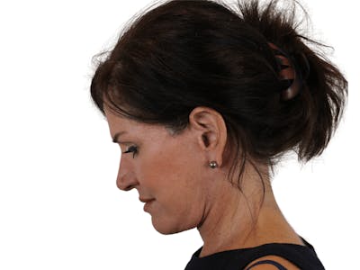 Neck Lift Before & After Gallery - Patient 121845161 - Image 14