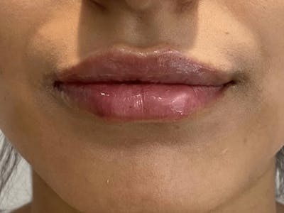 Lip Filler Before & After Gallery - Patient 121871652 - Image 2
