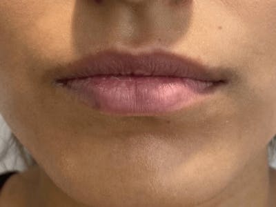 Lip Filler Before & After Gallery - Patient 121871652 - Image 1