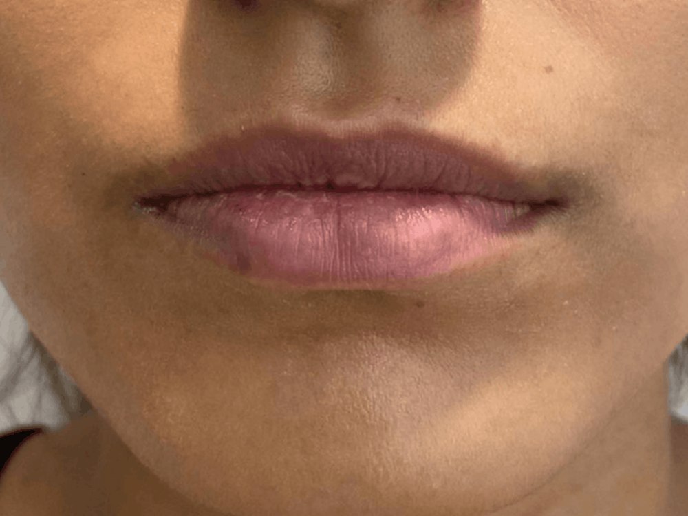 Lip Filler Before & After Gallery - Patient 121871652 - Image 1