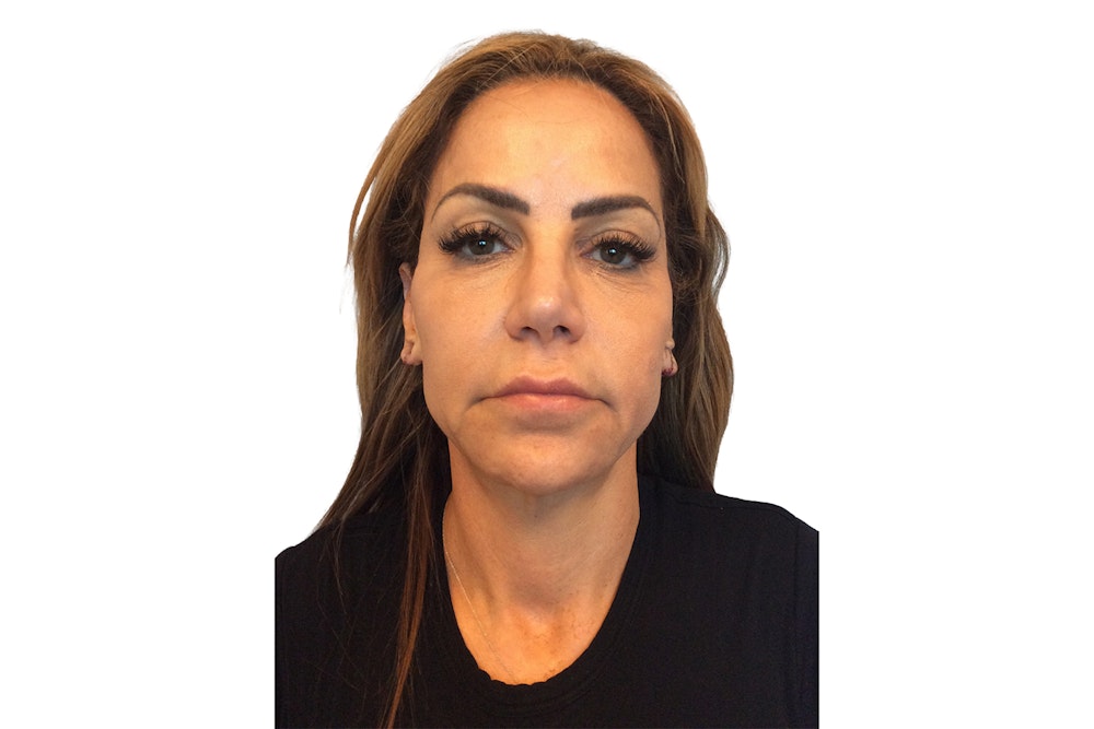 Facelift Before & After Gallery - Patient 13948525 - Image 1