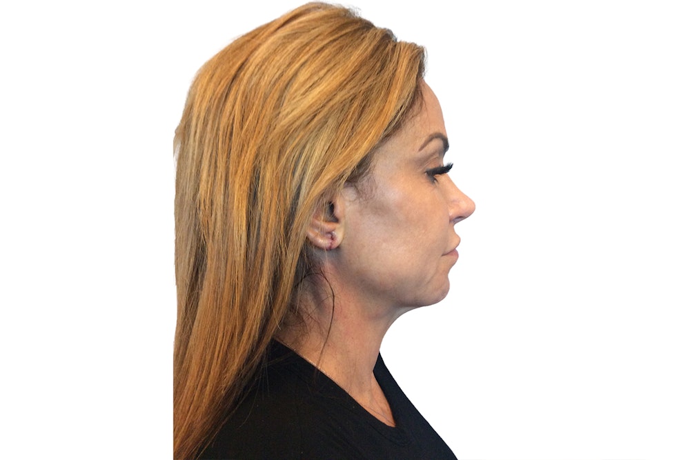 Deep Plane Facelift Before & After Gallery - Patient 13948525 - Image 5