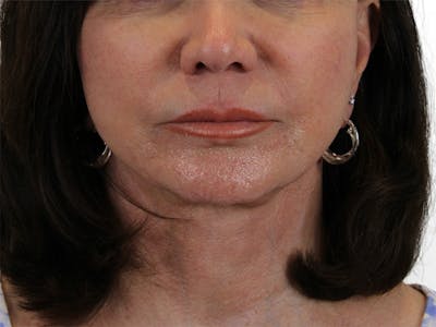 Chin Filler Before & After Gallery - Patient 122608987 - Image 1