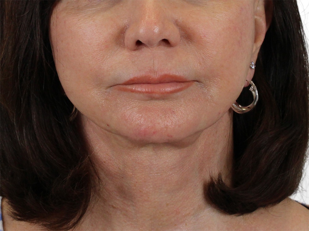 Chin Filler Before & After Gallery - Patient 122608987 - Image 2