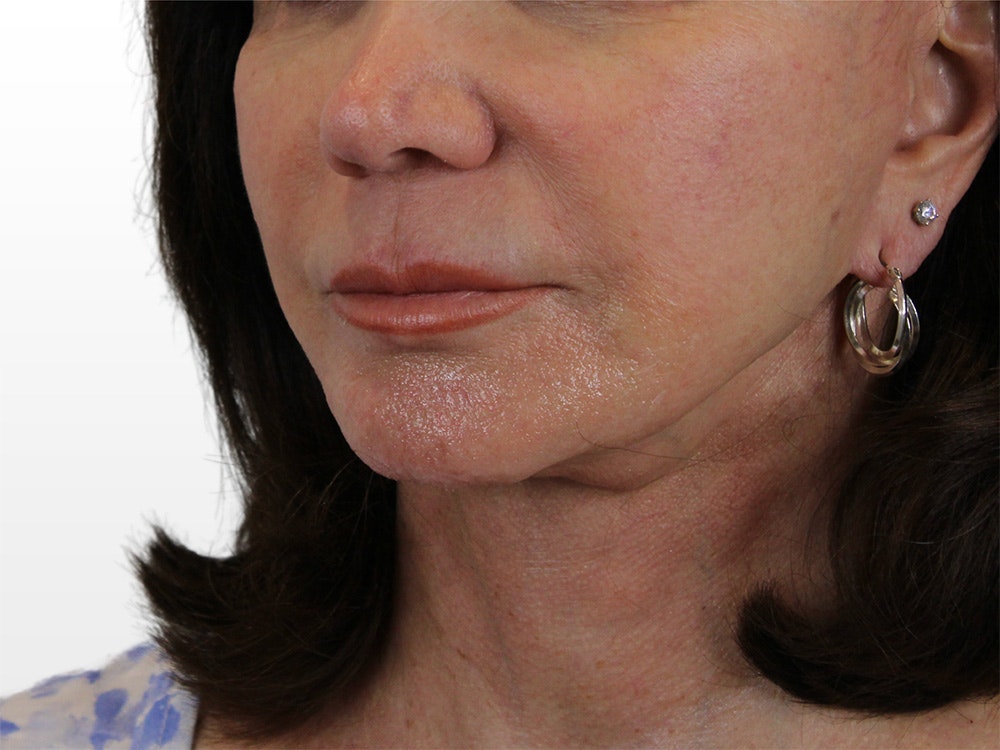 Chin Filler Gallery - Patient 122608987 - Image 3