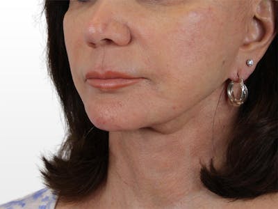 Chin Filler Before & After Gallery - Patient 122608987 - Image 4