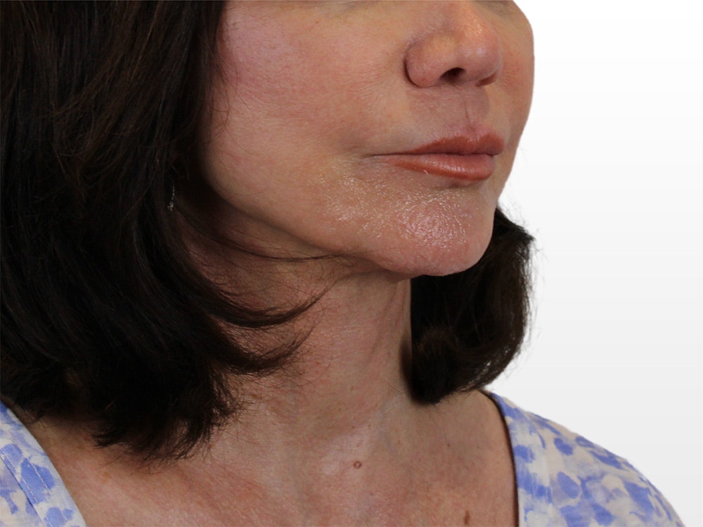 Chin Filler Gallery - Patient 122608987 - Image 5