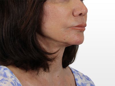 Chin Filler Before & After Gallery - Patient 122608987 - Image 6