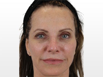 Sciton HALO Before & After Gallery - Patient 122597770 - Image 2