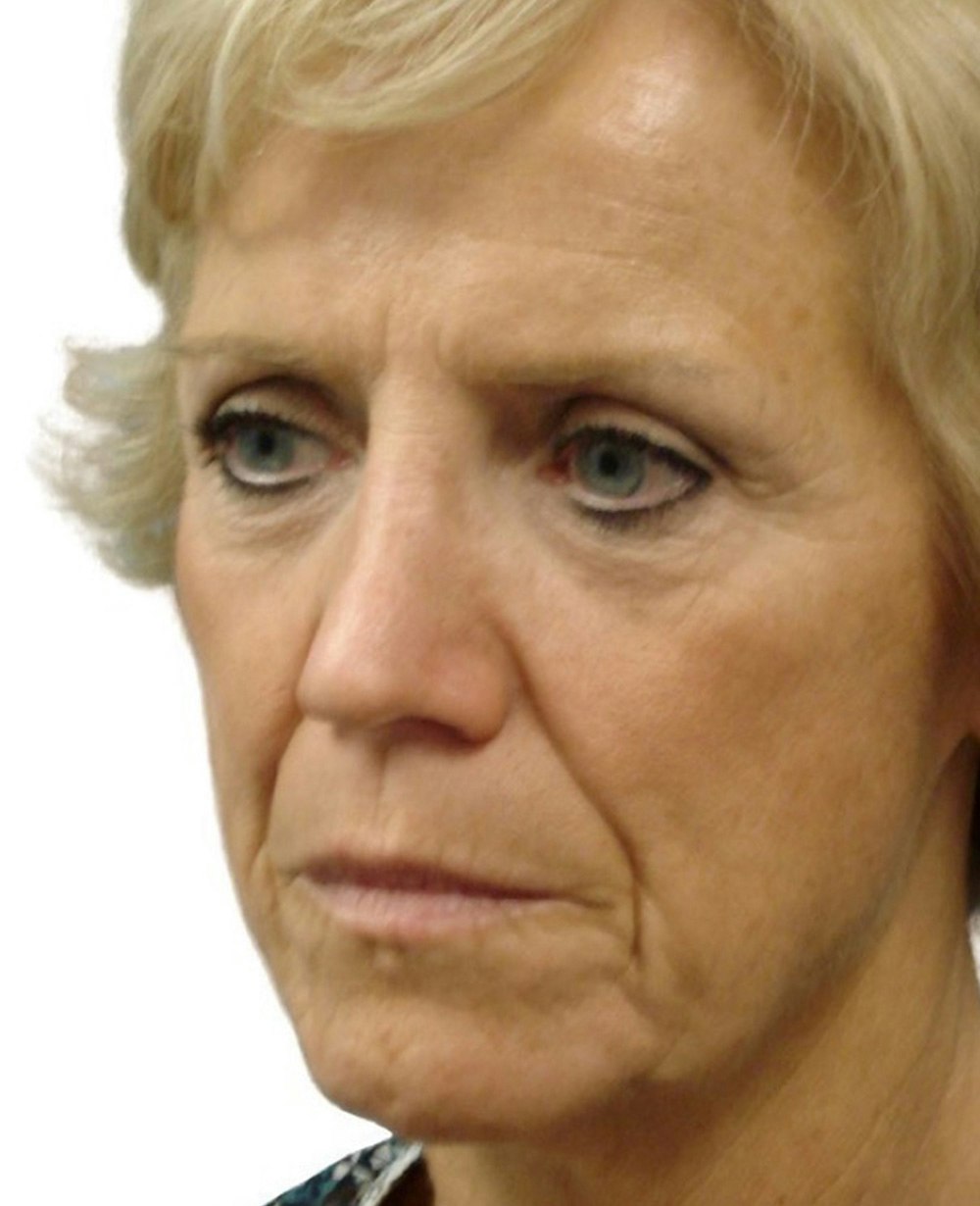 Deep Plane Facelift Before & After Gallery - Patient 13948528 - Image 3
