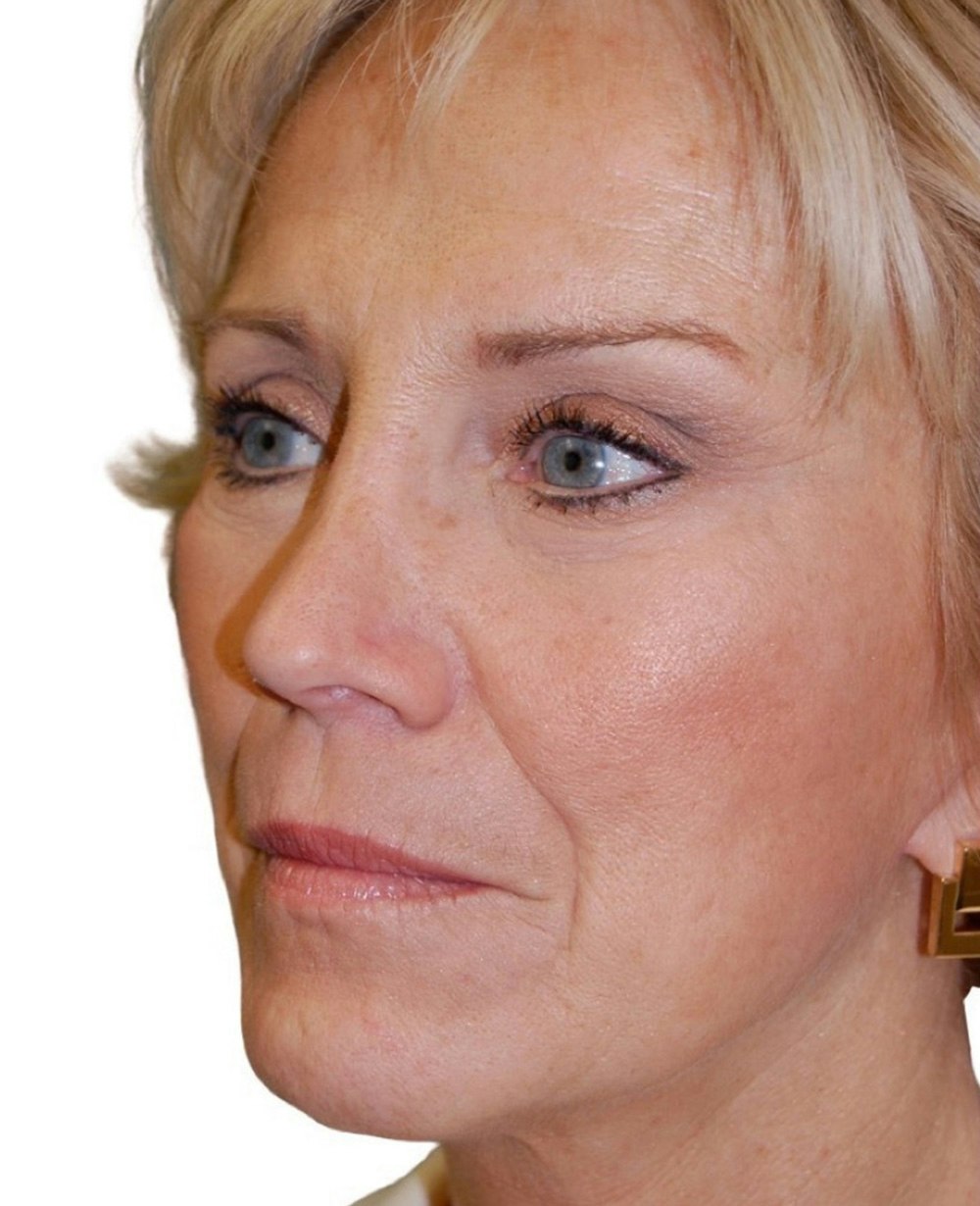 Facelift Before & After Gallery - Patient 13948528 - Image 4