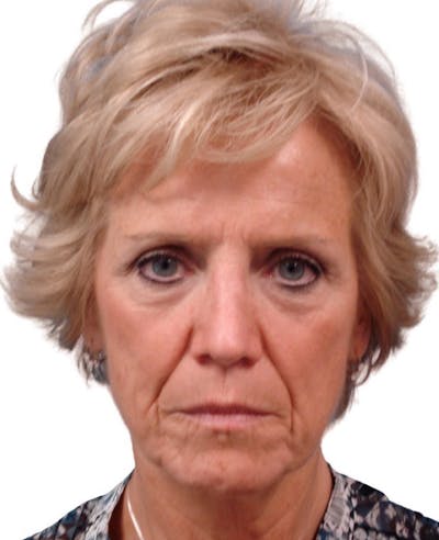 Deep Plane Facelift Before & After Gallery - Patient 13948528 - Image 1